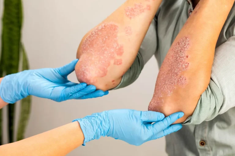 Dermatologists Diagnose and Treat Eczema