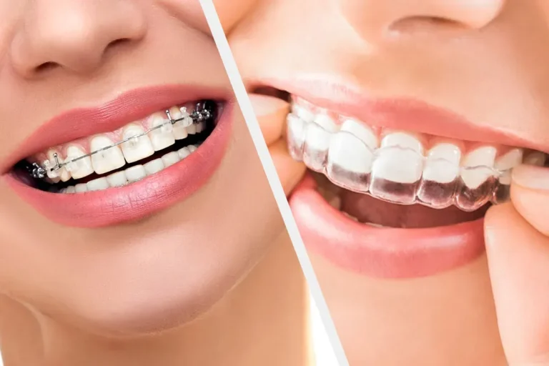 Invisalign vs. Traditional Braces