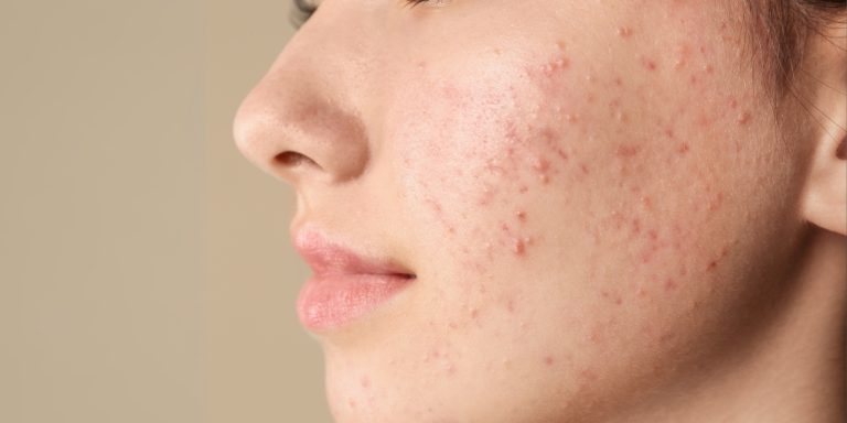 Reason Behind Acne, Dryness, and Sensitivity