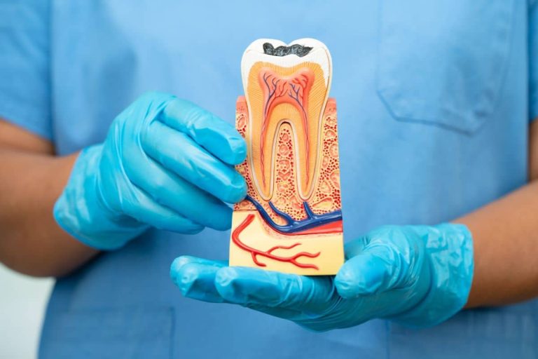 Aftercare Tips for a Successful Root Canal Recovery