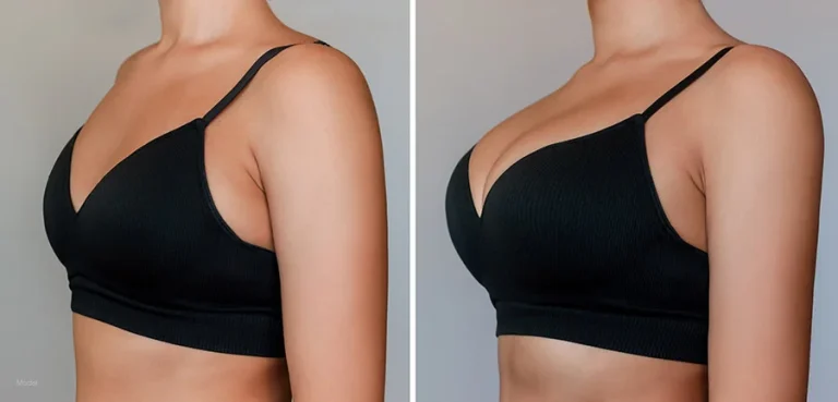Before and After Breast Augmentation