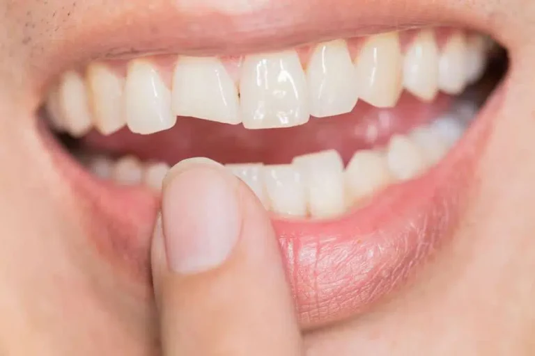 Cosmetic Dentists Process for Fixing Damaged Teeth