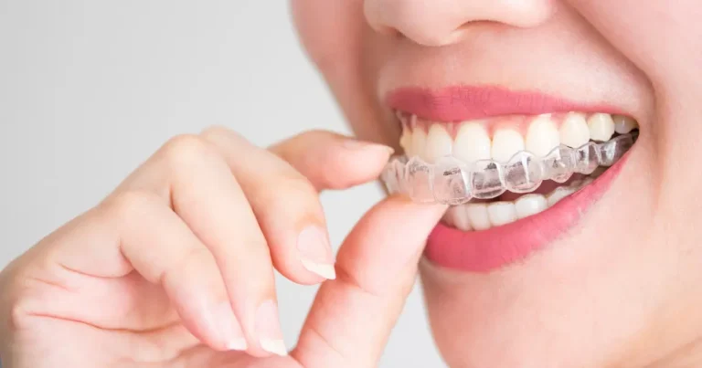 Different Types of Invisible Braces Available