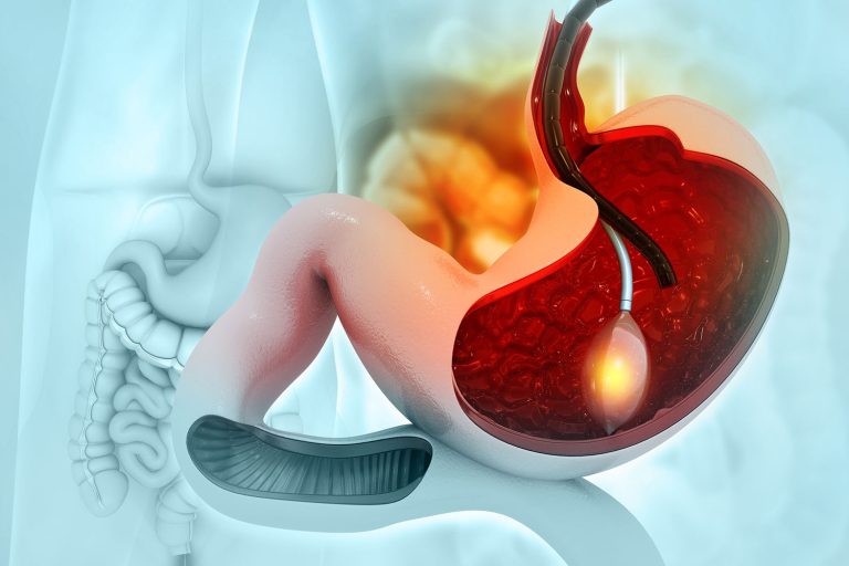 Gastric Bypass Surgery