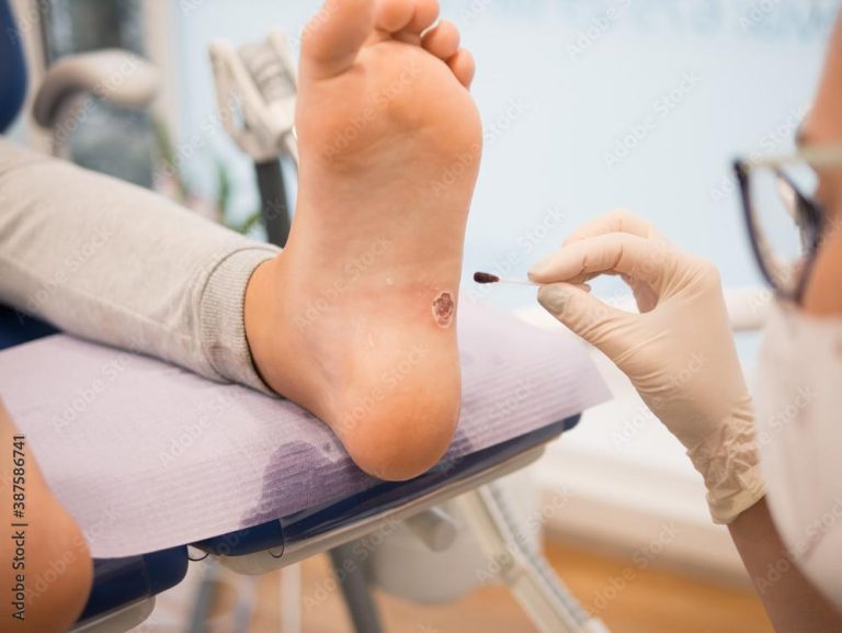 What to Expect From a Visit to a Plantar Wart Specialist Visit to a Plantar Wart Specialist