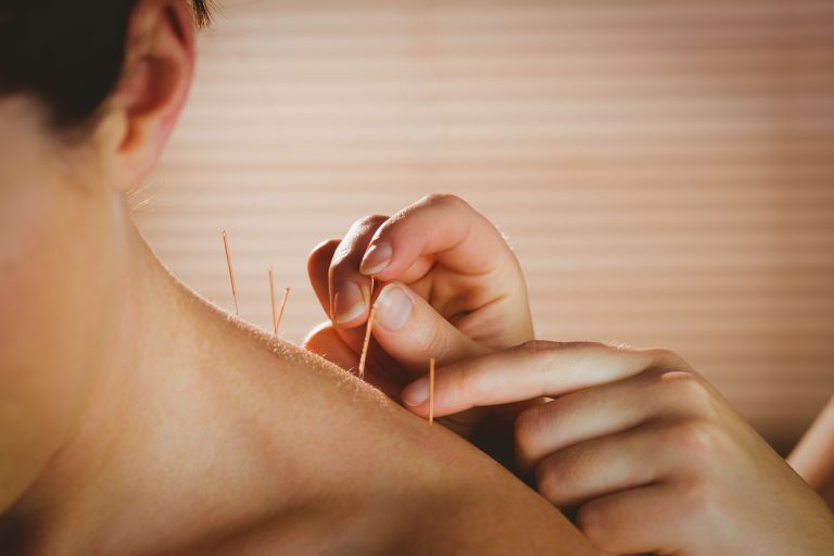 Acupuncture Can Enhance Your Overall Well-being