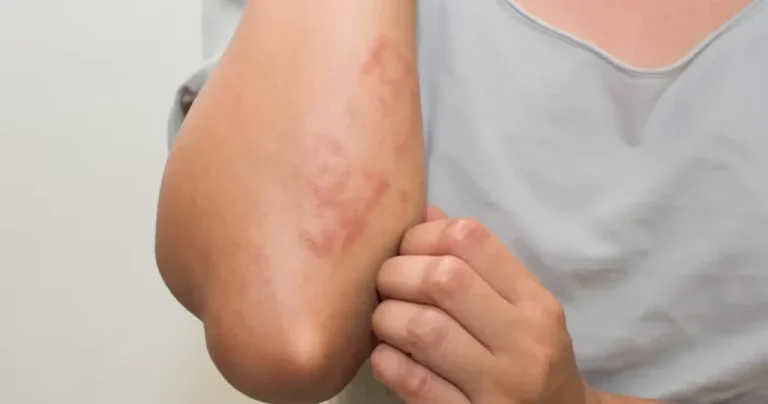 Common Skin Conditions