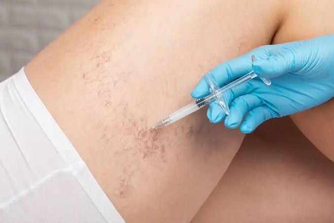 Questions to Ask Your Doctor Before Sclerotherapy Sclerotherapy