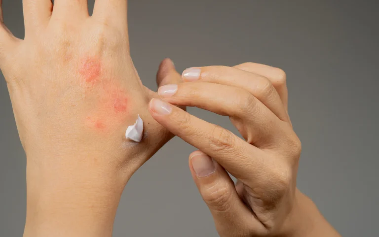 Skincare Routine for Eczema-prone Skin