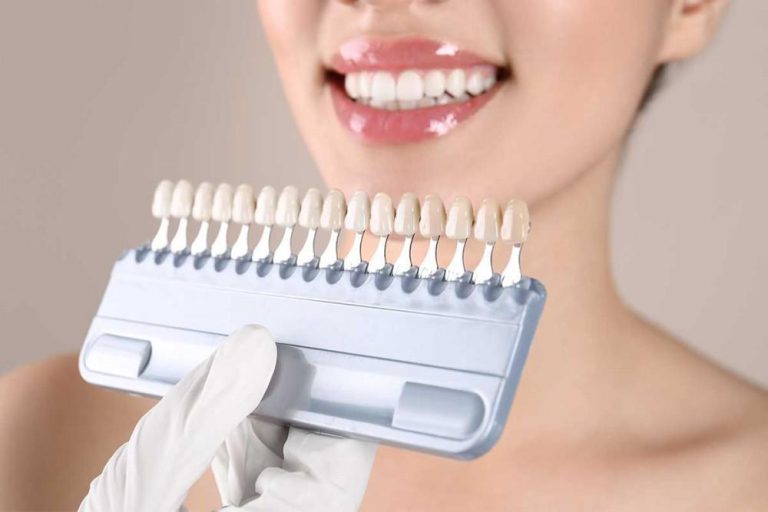 Veneers Can Transform Your Smile