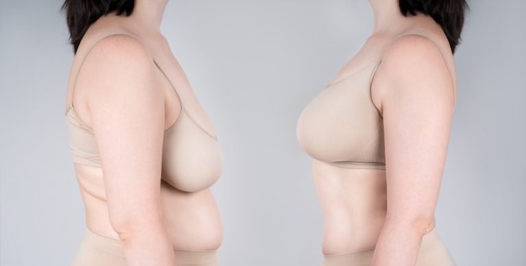 Youthful Appearance With a Breast Lift