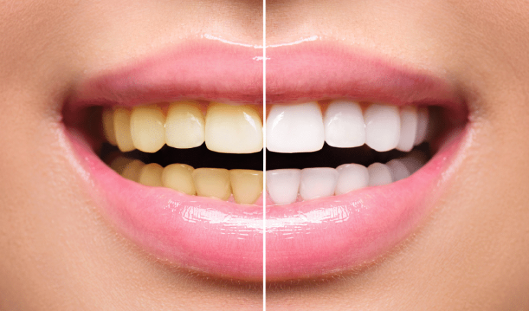 Choosing the Right Teeth Whitening Method for Your Smile Teeth Whitening Method